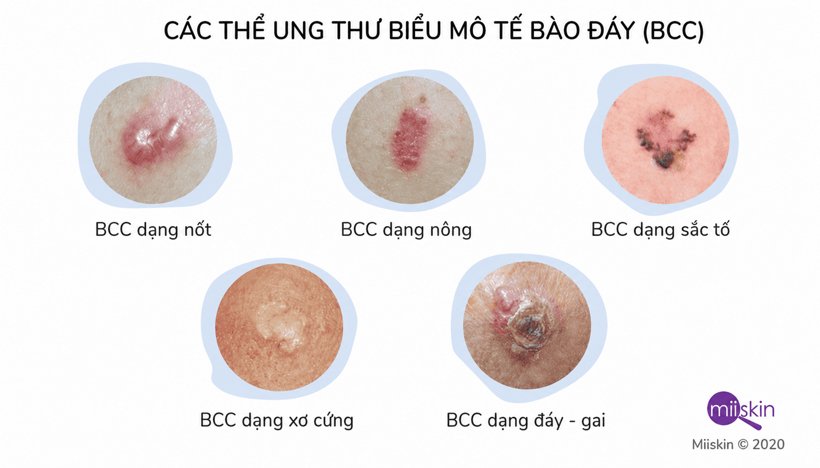 các thể ung thư biểu mô tế bào đáy