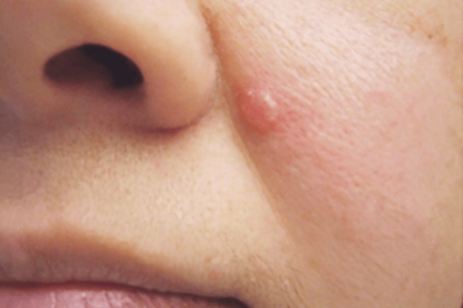 ung thư biểu mô tế bào đáy, hay basal cell carcinoma (BCC), là loại ung thư da phổ biến nhất