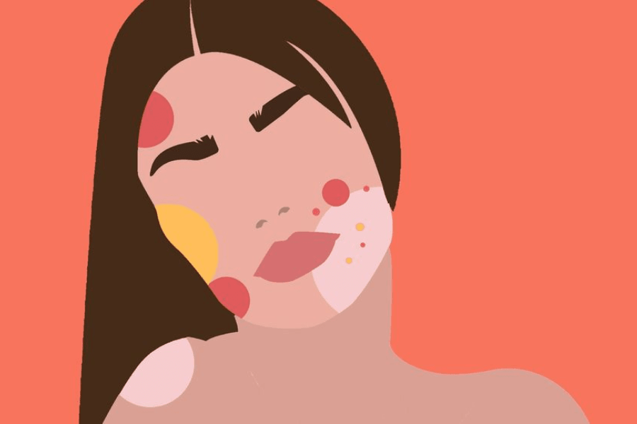 Tình trạng nổi mụn có thể chịu chịu ảnh hưởng của nhiều yếu tố khác như nội tiết tố, chế độ ăn uống và lối sống