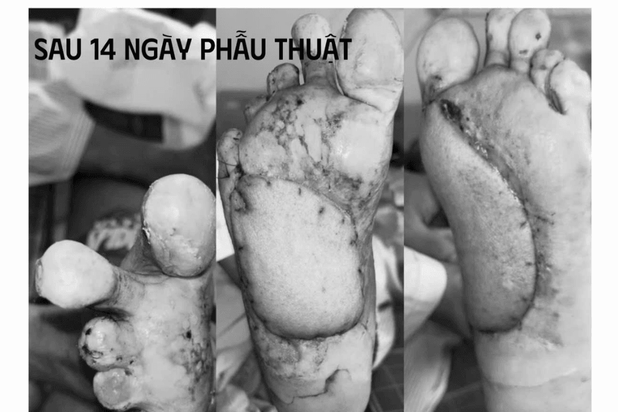 Sau 14 ngày, hai vạt mô sống tốt và người bệnh bắt đầu tập đặt chân xuống đất, chịu lực từng bước để phục hồi khả năng đi lại