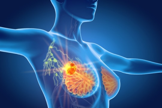 'Chung tay vì người phụ nữ tôi yêu' nâng cao nhận thức về bệnh ung thư vú