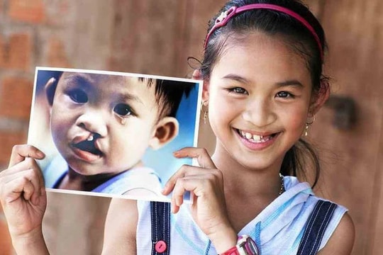 Phẫu thuật hở hàm ếch với chi phí 0 đồng