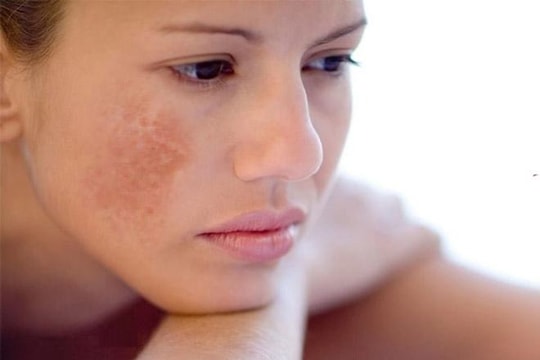 Bác sĩ chỉ cách điều trị tàn nhang hiệu quả