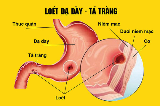 Người trẻ bị loét dạ dày vì stress, thức khuya, bỏ bữa