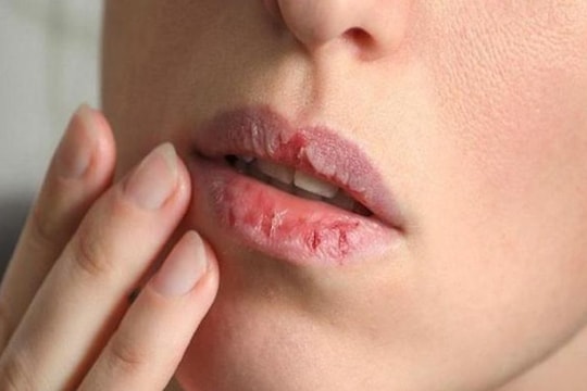 Tại sao bị khô miệng?