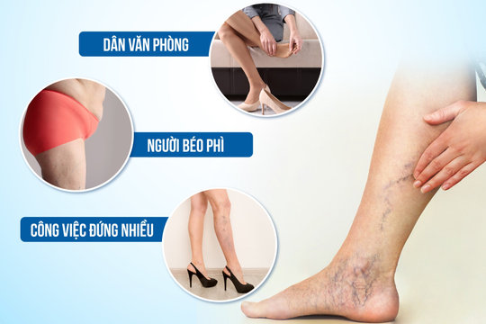 Phụ nữ bị suy giãn tĩnh mạch cao gấp 3 lần nam giới
