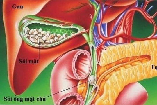Bệnh túi mật sứ là gì, nguy hiểm ra sao?