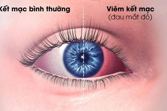 Ngày Tết gặp và nhìn nhau có bị lây đau mắt đỏ không?