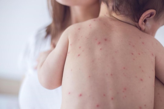 Bệnh đậu mùa khỉ: Cà Mau có chỉ đạo "nóng"