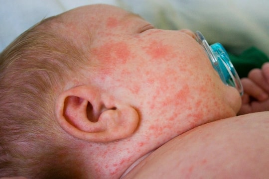 Bệnh sởi vào mùa, chuyên gia hướng dẫn cách chăm sóc, phòng bệnh