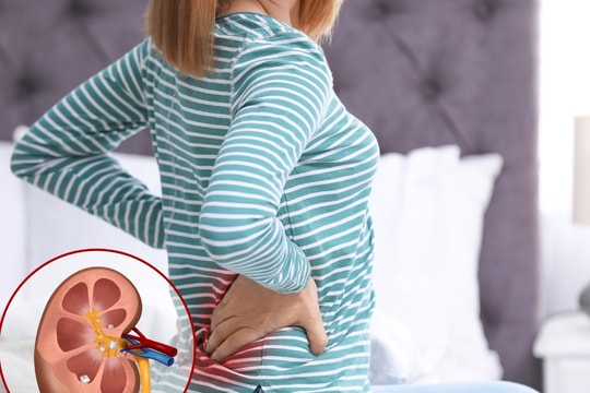 Sỏi thận: Nguyên nhân, triệu trứng và cách phòng ngừa