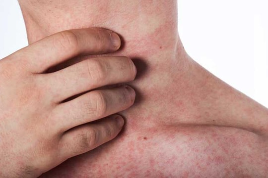 TP. Hồ Chí Minh chủ động phòng bệnh sốt xuất huyết khi mùa mưa đến