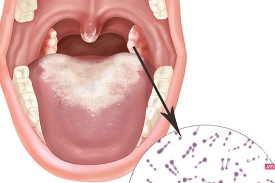 Bắc Giang cách ly ca bệnh bạch hầu, ngăn ngừa lây lan rộng