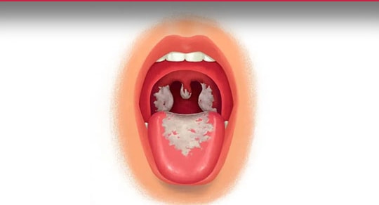 Bệnh bạch hầu có lây truyền qua đường tình dục?