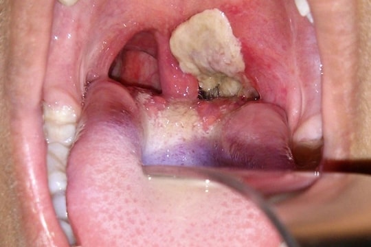 Chuyên gia dịch tễ khuyến cáo gì về bệnh bạch hầu?