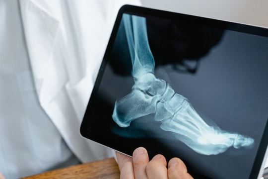 Chế độ ăn cho người bệnh ung thư xương