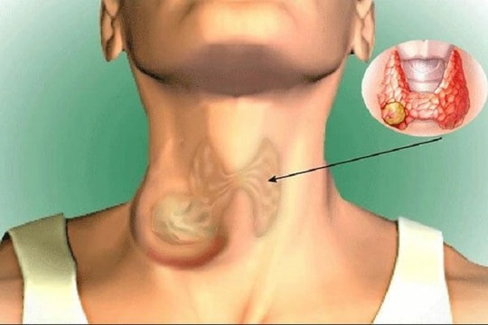 Bệnh nhân ung thư tuyến giáp chia sẻ 4 kinh nghiệm quý