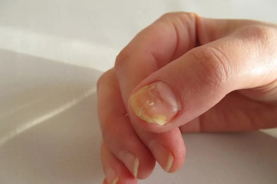 Nấm móng mùa mưa phòng thế nào?