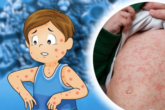 3 trẻ em mắc bệnh sởi ở TP.HCM tử vong