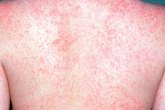 Cách xử lý, giải quyết và phòng ngừa bệnh sởi