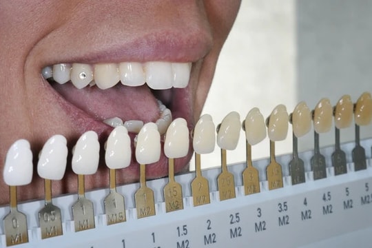 Những lý do khiến răng ố vàng ít người biết