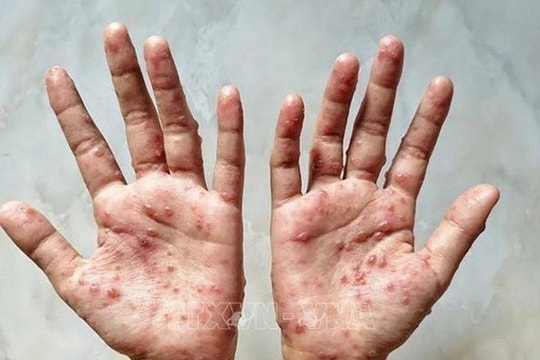 Khu vực phía Nam ghi nhận 199 ca đậu mùa khỉ, 8 ca tử vong trong 20 tháng qua