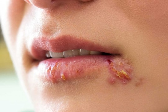 Bệnh zona thần kinh (giời leo): nhận thức đúng để phòng tránh, điều trị kịp thời