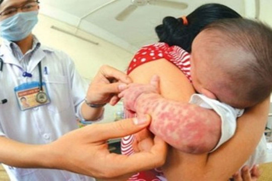 Đã có hơn 500 mắc, 3 ca tử vong do sởi, TPHCM đủ điều kiện công bố dịch?