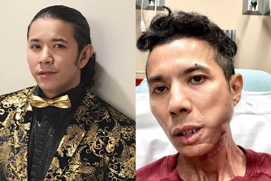 Căn bệnh khiến Kasim Hoàng Vũ tiều tuỵ, gương mặt biến dạng nguy hiểm thế nào?