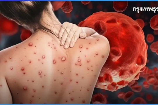 Mỹ bùng phát Covid-19, Bỉ có gần 900 ổ dịch bệnh lưỡi xanh, Thái Lan ngăn lan dịch đậu mùa khỉ