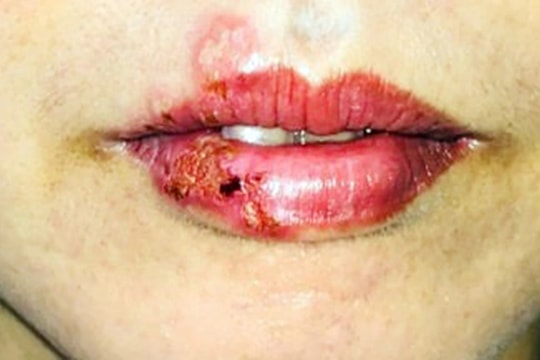 Nguy cơ biến chứng khi xăm hình: Cảnh báo từ các chuyên gia