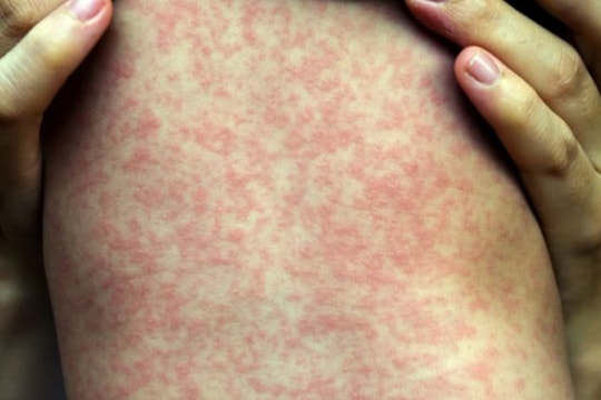 Bộ Y tế nói gì về việc TPHCM công bố dịch sởi trên địa bàn?