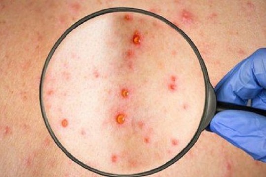 Biểu hiện bệnh sởi ở người lớn như thế nào?