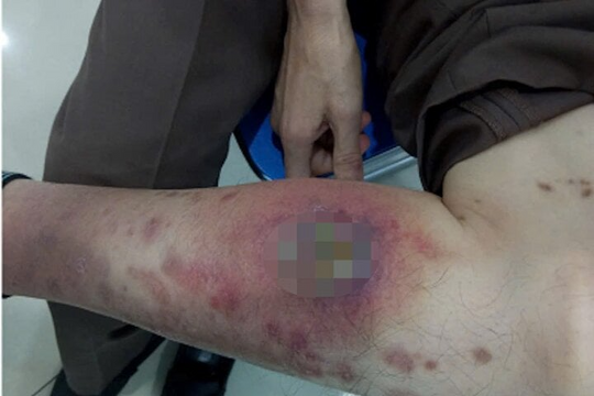 Lở loét cơ thể, nhập viện cấp cứu do 'tự làm bác sĩ' tại nhà