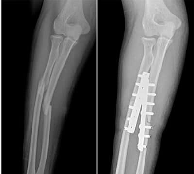 Chơi vật tay, nam thanh niên tập gym bị gãy tay