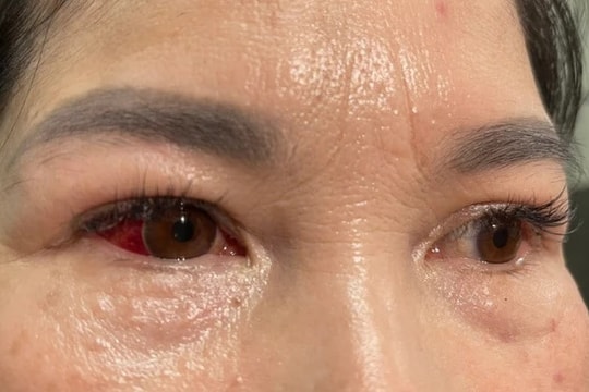 Hội chứng viêm kết mạc cấp mùa mưa lũ