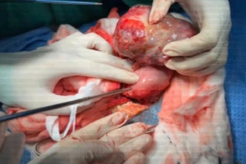 Em bé thường xuyên ọc sữa, cảnh báo mắc một căn bệnh hiếm