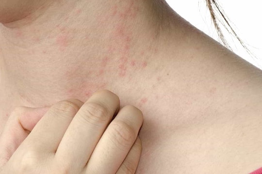 Các biến chứng nghiêm trọng của bệnh sởi