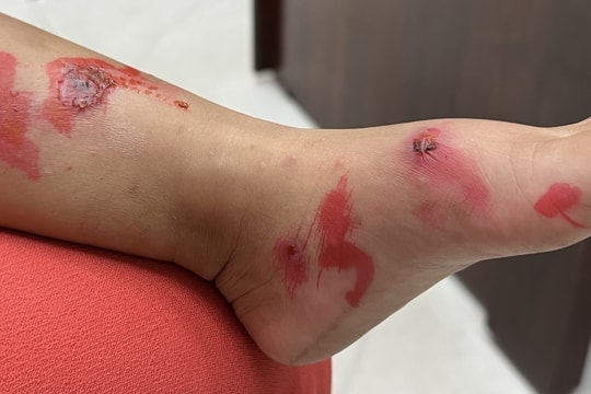 Số ca trẻ mắc bệnh chốc gia tăng, cảnh báo nguy cơ lây nhiễm tại trường học