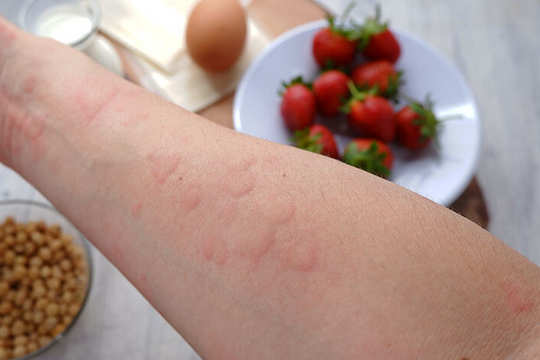 Triệu chứng và cơ chế gây sốc phản vệ?