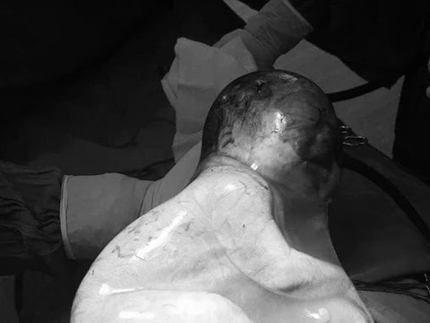 Em bé chào đời trong bọc điều khiến các bác sĩ ngạc nhiên