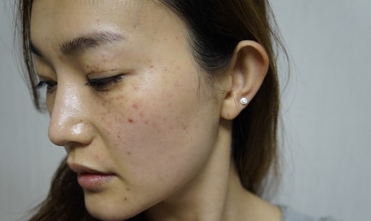 Yêu bản thân - Kì 2: Tàn nhang là phong ấn hay dấu ấn của sự tự tin?