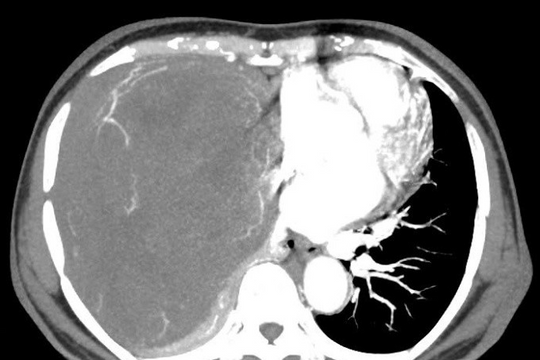 Đọc báo giùm bạn 1/10/2024: Khối u 2kg đè xẹp phổi. Bỏng nặng vì giác hơi bụng để chữa ung thư. Xăm hồng nhủ hoa dẫn đến nhiễm trùng