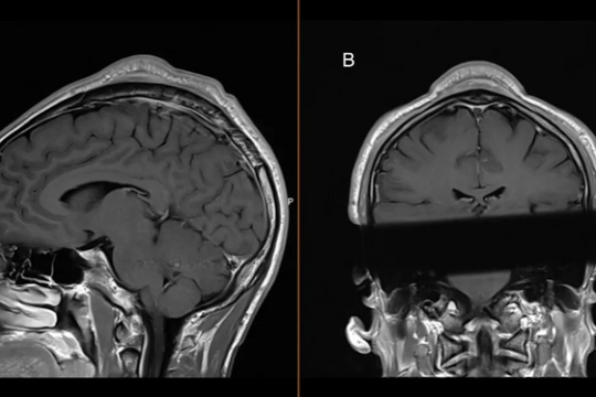 "Mọc" khối u sau nhiều thập kỷ tập breakdance
