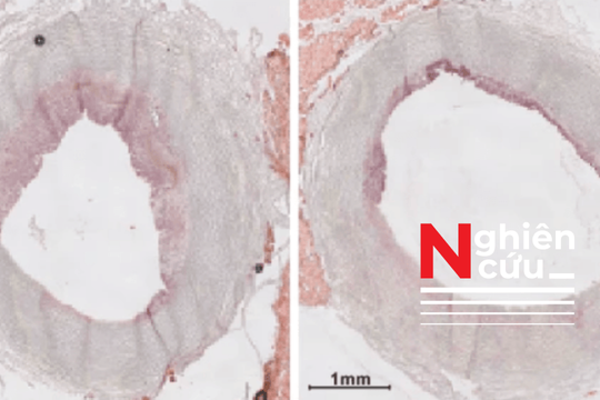 Đột phá trong điều trị tim mạch: Liệu pháp hạt nano giúp giảm mảng bám trong động mạch