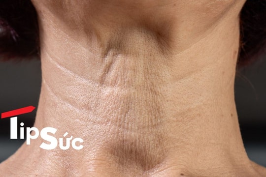 Cách chăm sóc cho vùng cổ bị lão hóa