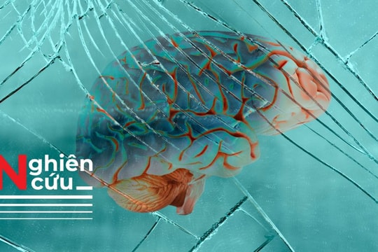 Alzheimer có thể do virus herpes lây từ ruột lên não