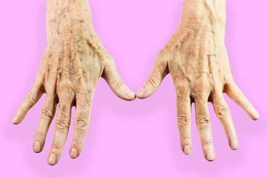 9 dấu hiệu "báo động" sức khỏe trên bàn tay