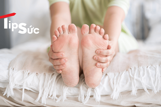 Bí quyết sống chung với bệnh gout mãn tính