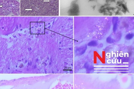 Vi nhựa trong não cao gấp 30 lần trong gan và thận